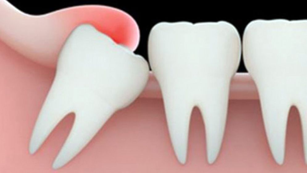 Wisdom tooth pain: why does it happen,