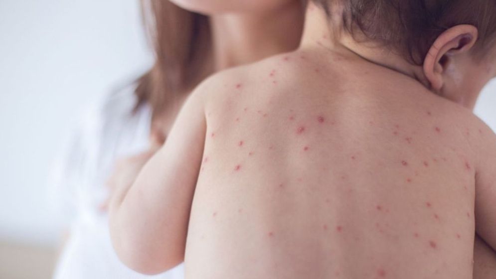 Measles surge: 888 suspected cases and one fatality recorded in 24 hours