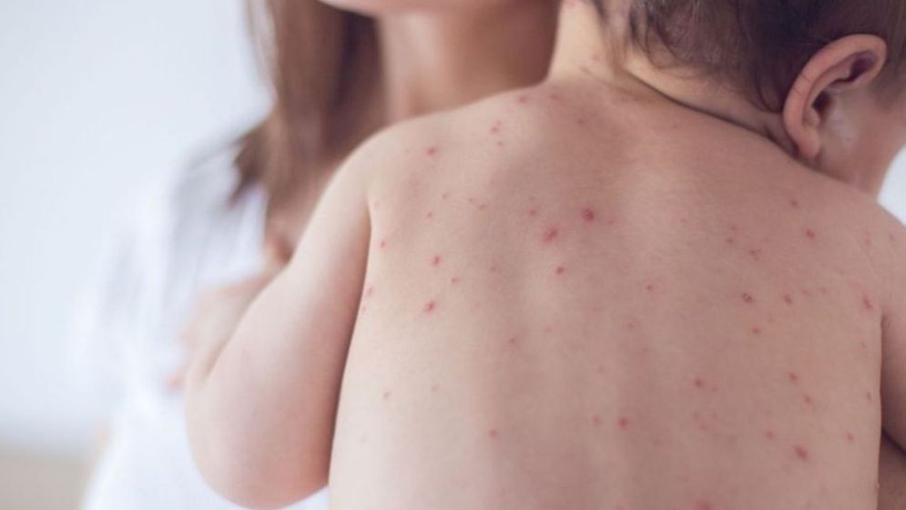 Measles Outbreak Claims Five More Children in 24 Hours