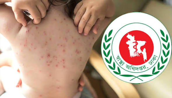 7 more children die from measles symptoms.