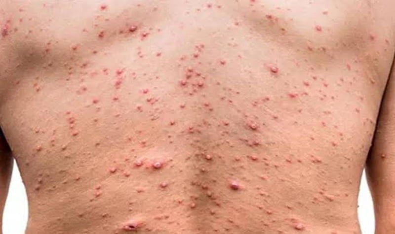 More than 16 thousand people are infected with monkeypox in 75 countries