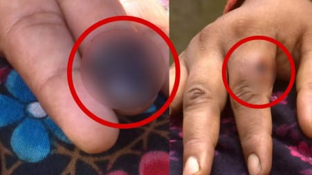 Mysterious livestock-linked disease sparks panic in Rangpur